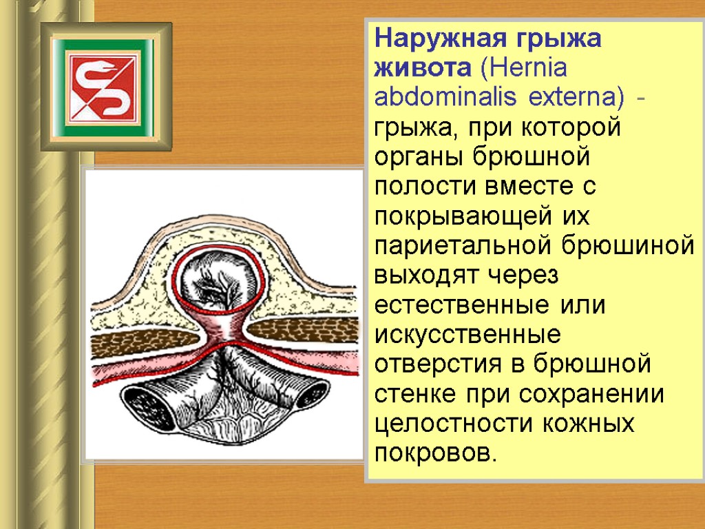 Наружная грыжа живота (Hernia abdominalis externa) - грыжа, при которой органы брюшной полости вместе